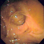 Diverticulitis