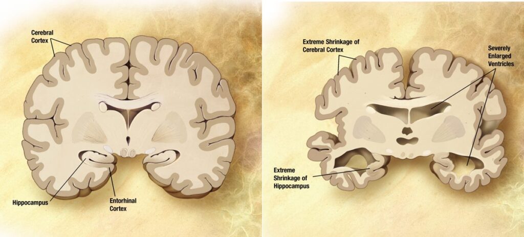 Comparación entre un cerebro sano y un cerebro con enfermedad de Alzheimer mostrando la atrofia cerebral