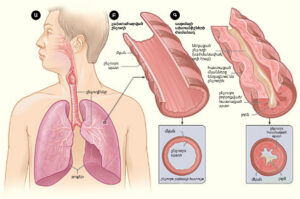 Asma: inflamación crónica de las vías respiratorias