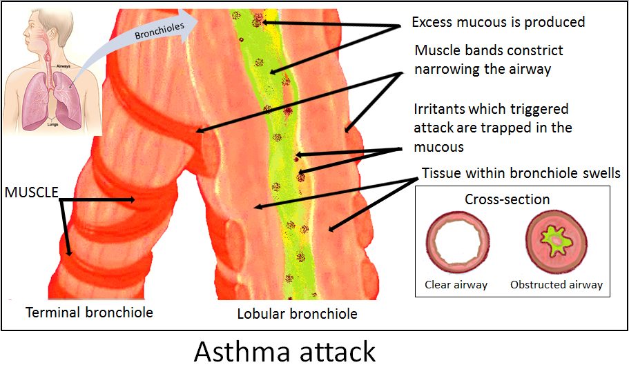 Diagrama de vías respiratorias normales vs asmáticas