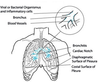 Ilustración de bronquitis aguda