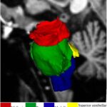 Bulbo raquídeo: anatomía, función y importancia vital