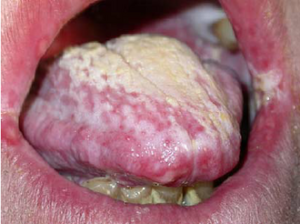 Candidiasis oral: infección por Candida albicans en la boca