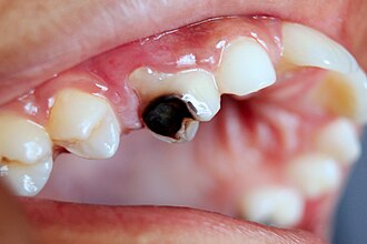 Caries dental: desmineralización del esmalte y prevención con flúor