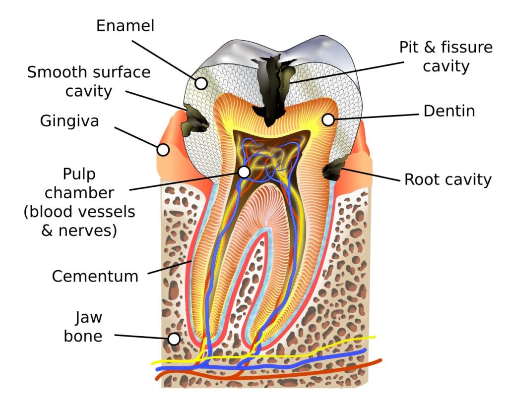 Diagrama de un diente con caries dental