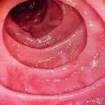 Enfermedad celíaca: intolerancia al gluten y atrofia vellositaria