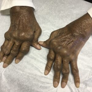 Artritis reumatoide: inflamación crónica de las articulaciones