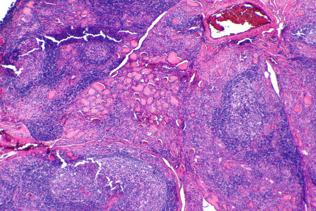 Tiroiditis de Hashimoto