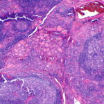 Tiroiditis de Hashimoto: hipotiroidismo autoinmune