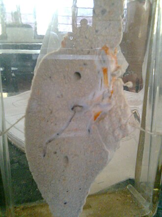 Cirrosis hepática: fibrosis hepática, hipertensión portal y trasplante