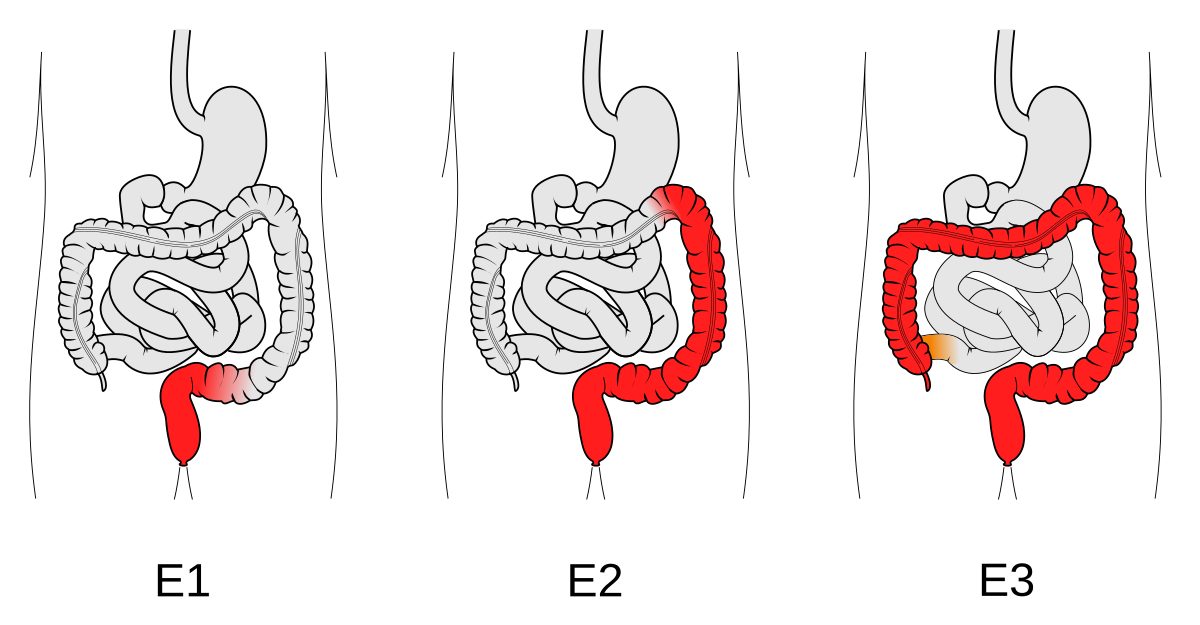 Diagrama del colon afectado por colitis ulcerosa