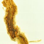 Enfermedad de Crohn: inflamación intestinal crónica transmural