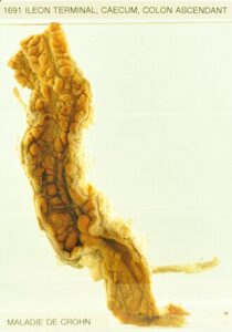 Enfermedad de Crohn: inflamación intestinal crónica transmural