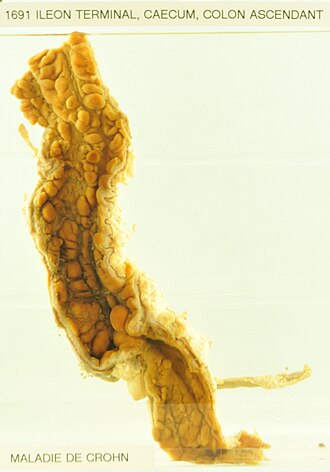 Enfermedad de Crohn: inflamación intestinal crónica transmural