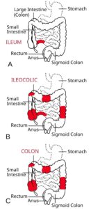 Enfermedad de Crohn: causas, síntomas y tratamiento