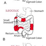 Enfermedad de Crohn: causas, síntomas y tratamiento