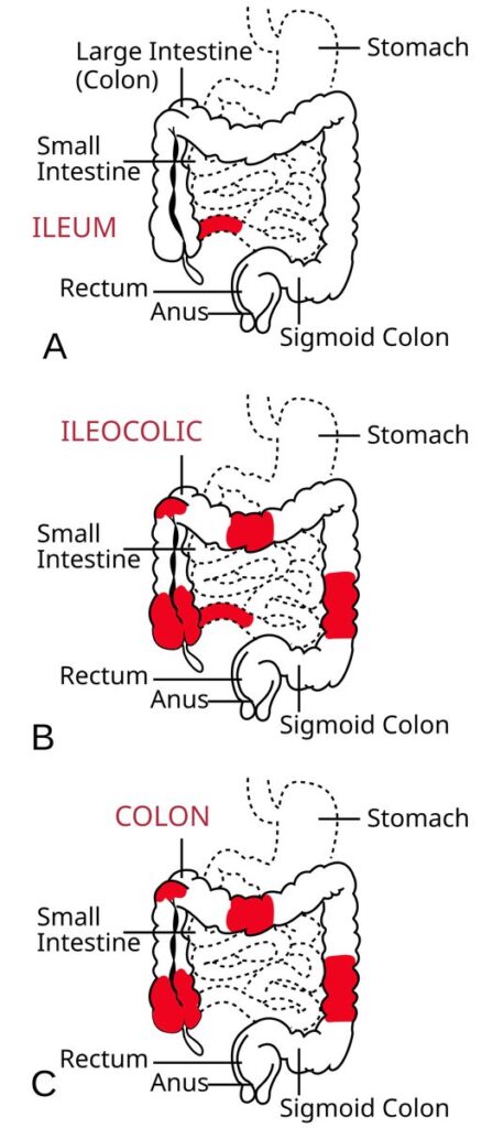 Diagrama del tracto digestivo afectado por enfermedad de Crohn