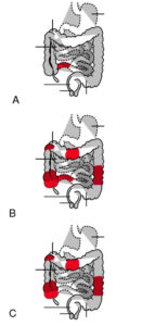 Enfermedad inflamatoria intestinal: Crohn y colitis ulcerosa