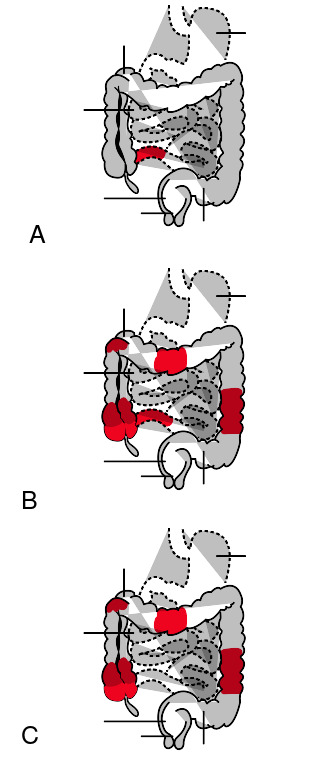 Patrones de la enfermedad de Crohn en el intestino