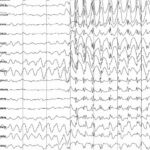 Epilepsia: tipos, causas, síntomas y tratamiento