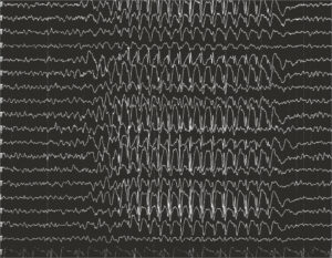 Epilepsia: crisis convulsivas y su tratamiento