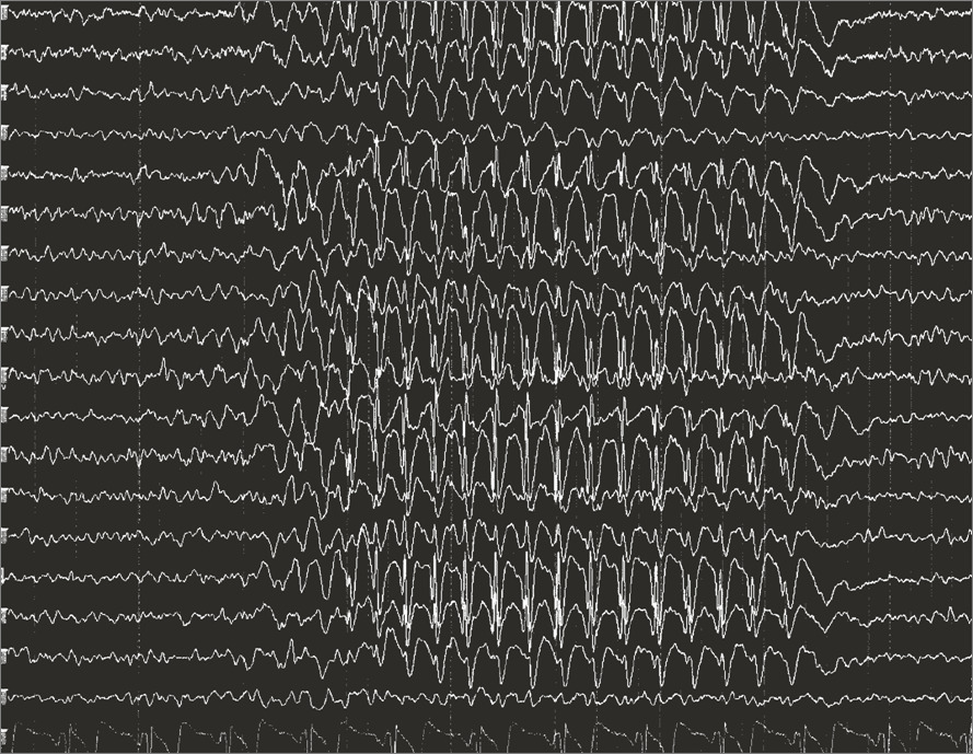 EEG mostrando crisis de ausencia epiléptica