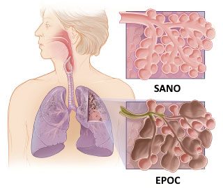 Diagrama de pulmones con EPOC