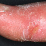 Esclerodermia: fibrosis sistémica autoinmune