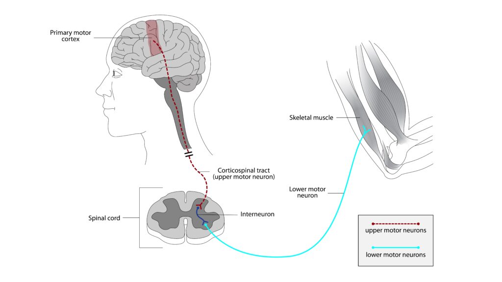 ELA (esclerosis lateral amiotrófica): síntomas, diagnóstico y tratamiento