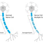 Esclerosis múltiple: causas, síntomas y tratamiento