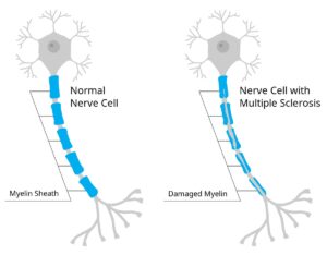 Esclerosis múltiple
