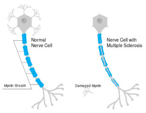 Esclerosis múltiple: cuando el sistema inmune ataca la mielina