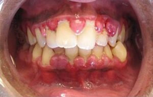 Gingivitis: inflamación de encías por placa bacteriana