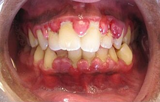 Gingivitis: inflamación de encías por placa bacteriana