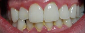Gingivitis: causas, síntomas, tratamiento y prevención