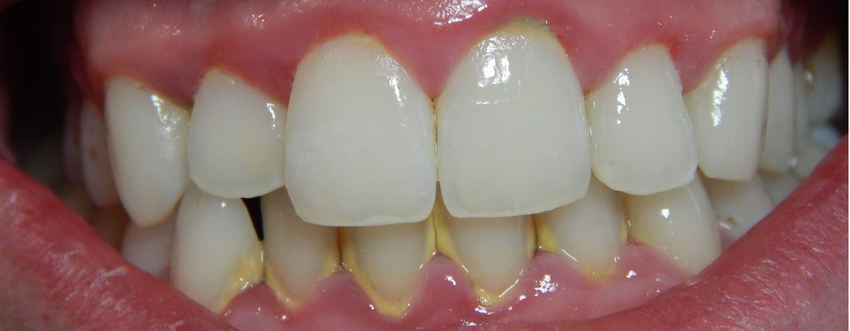 Imagen de encías con gingivitis