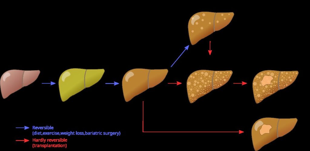 Diagrama de hígado graso vs hígado normal