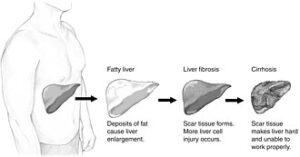 Hígado graso: esteatosis hepática, NAFLD y síndrome metabólico