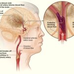 Ictus (ACV): causas, síntomas, tratamiento y prevención