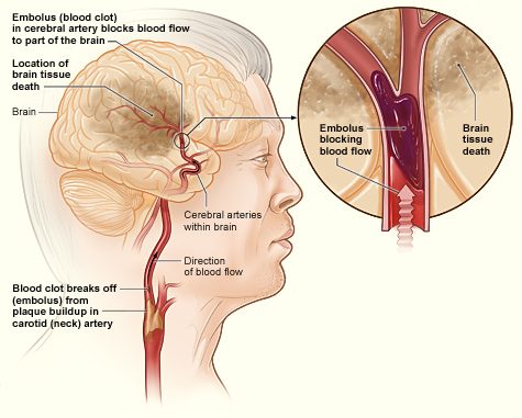 Diagrama de un accidente cerebrovascular mostrando la obstrucción arterial en el cerebro