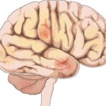Meningitis: causas, síntomas, diagnóstico y tratamiento
