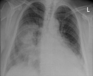 Neumonía: infección del tejido pulmonar