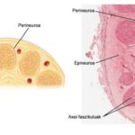 Neuropatía periférica: causas, síntomas y tratamiento