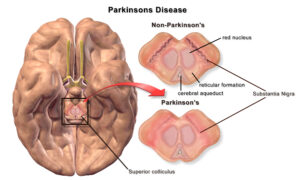 Parkinson: temblores y rigidez por pérdida de dopamina