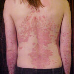 Psoriasis: inflamación crónica de la piel