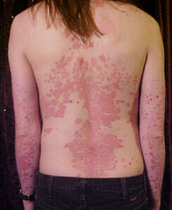 Psoriasis: inflamación crónica de la piel