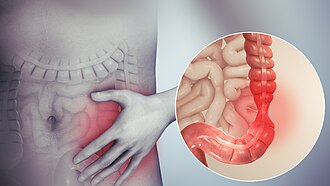 Síndrome de intestino irritable: trastorno funcional con dolor y cambios del ritmo intestinal