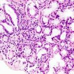 Síndrome de Sjögren: sequedad ocular y bucal autoinmune